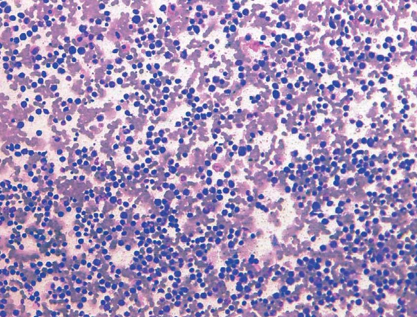 急性粒细胞白血病部分分化型-M2b型